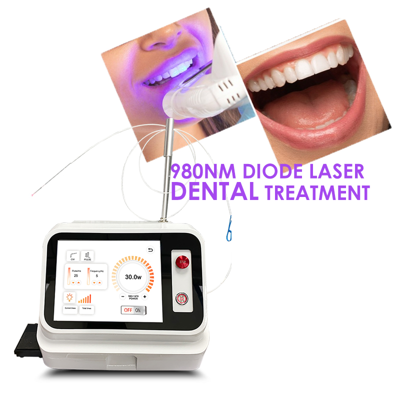 Teeth Whitening With Laser - جهاز ليزر للأسنان لعلاج الأنسجة الرخوة