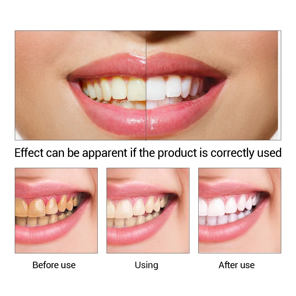Fteenly تبييض الأسنان جوهر مسح - مراجعة Teeth Whitening Street وسعره