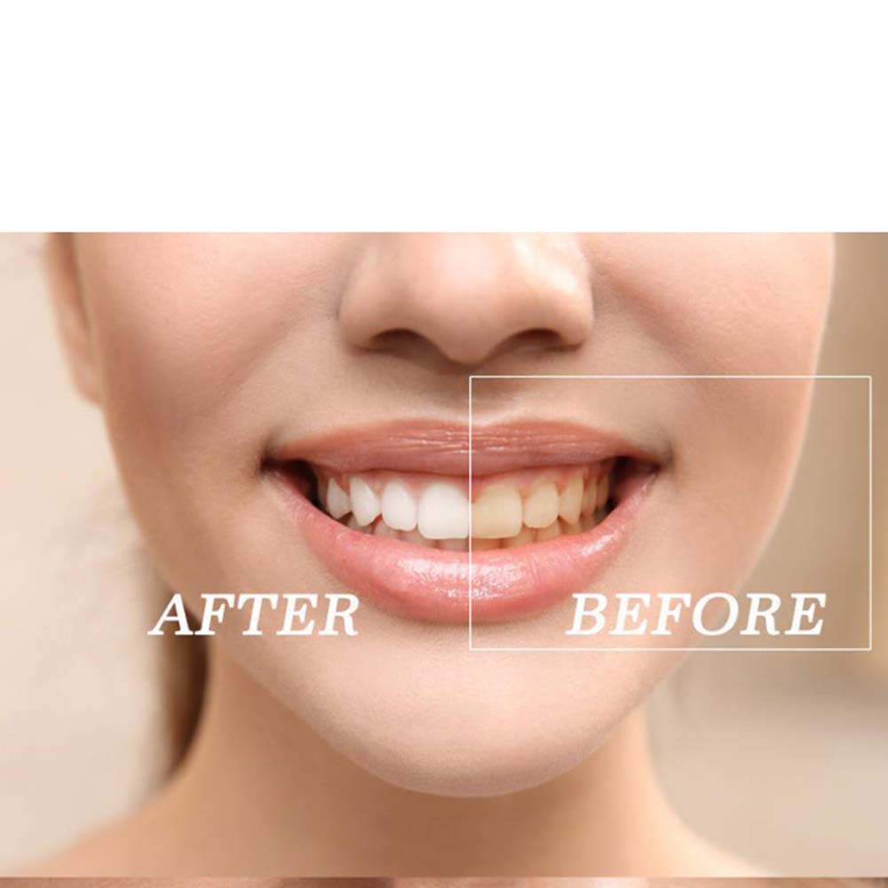 أعلى جودة بيروكسيد الأسنان تبي - مراجعة Teeth Whitening Led Kit وسعره