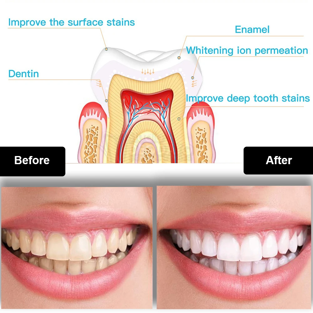 طقم تبييض الأسنان صغير 16 LED  - مراجعة Teeth Whitening Led Kit وسعره